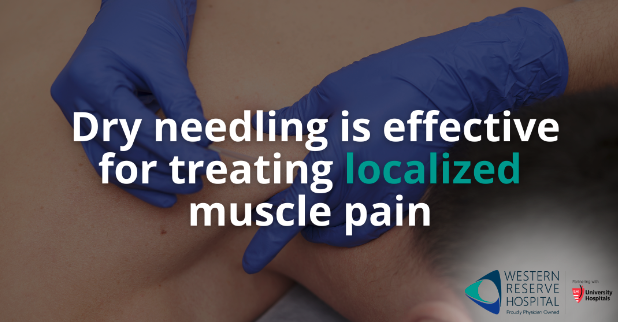 Dry Needling is Effective